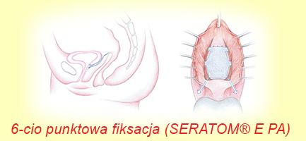 6-punktowa fikasacja